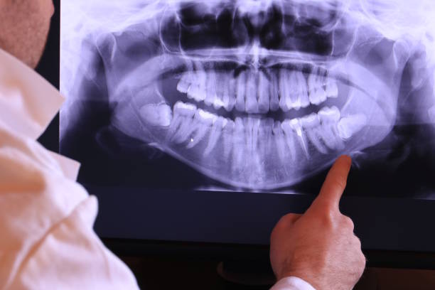 Best Emergency Wisdom Teeth Removal in Queens, NY